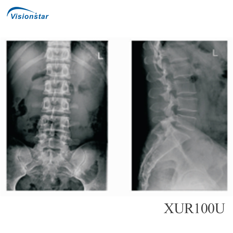 Xur100u Hospital Small Space Occupation High Freqency Radiography Photography Dr Dynamic UC Arm Digital X-ray System
