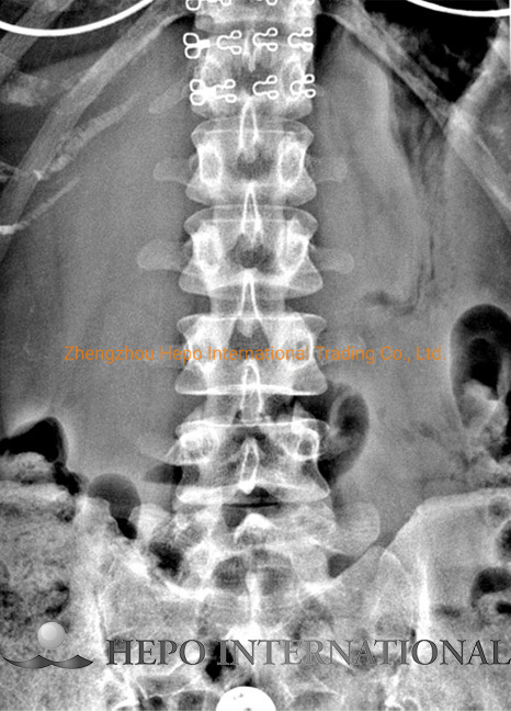 200mA High Frequency Medical Digital X Radiography System (HP-DRU260C)