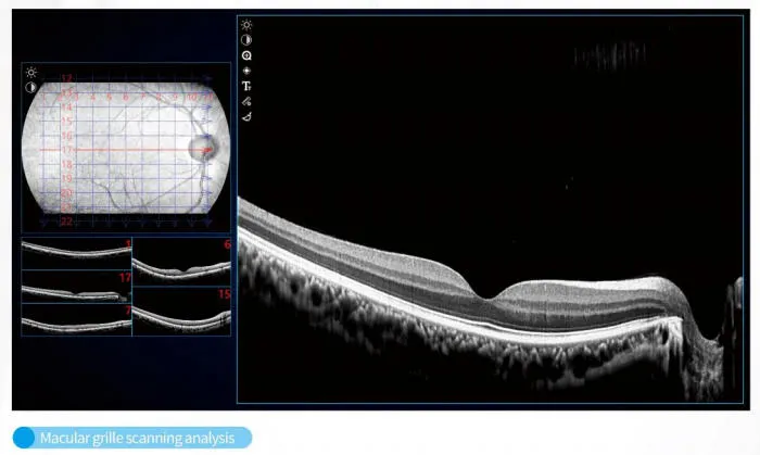 Macular Mapping