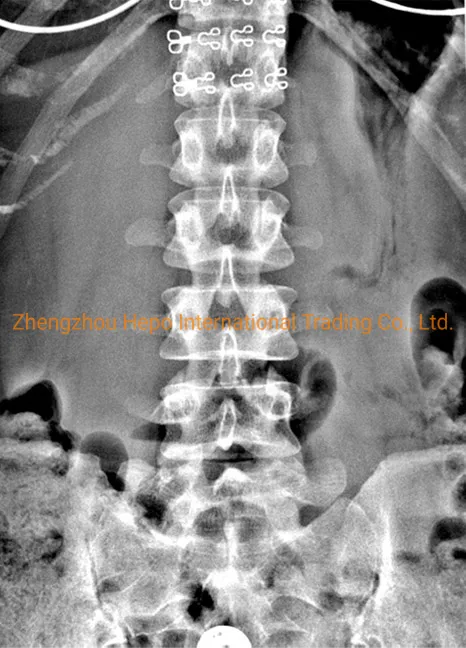 Digital X Radiography System