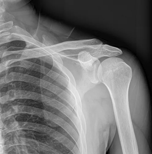 Medical Equipment Wireless Portable 17*17 Inch Digital X Ray Flat Panel Detector