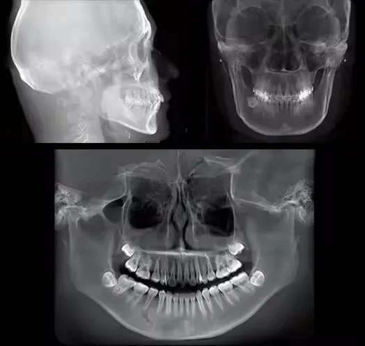 FOV CBCT