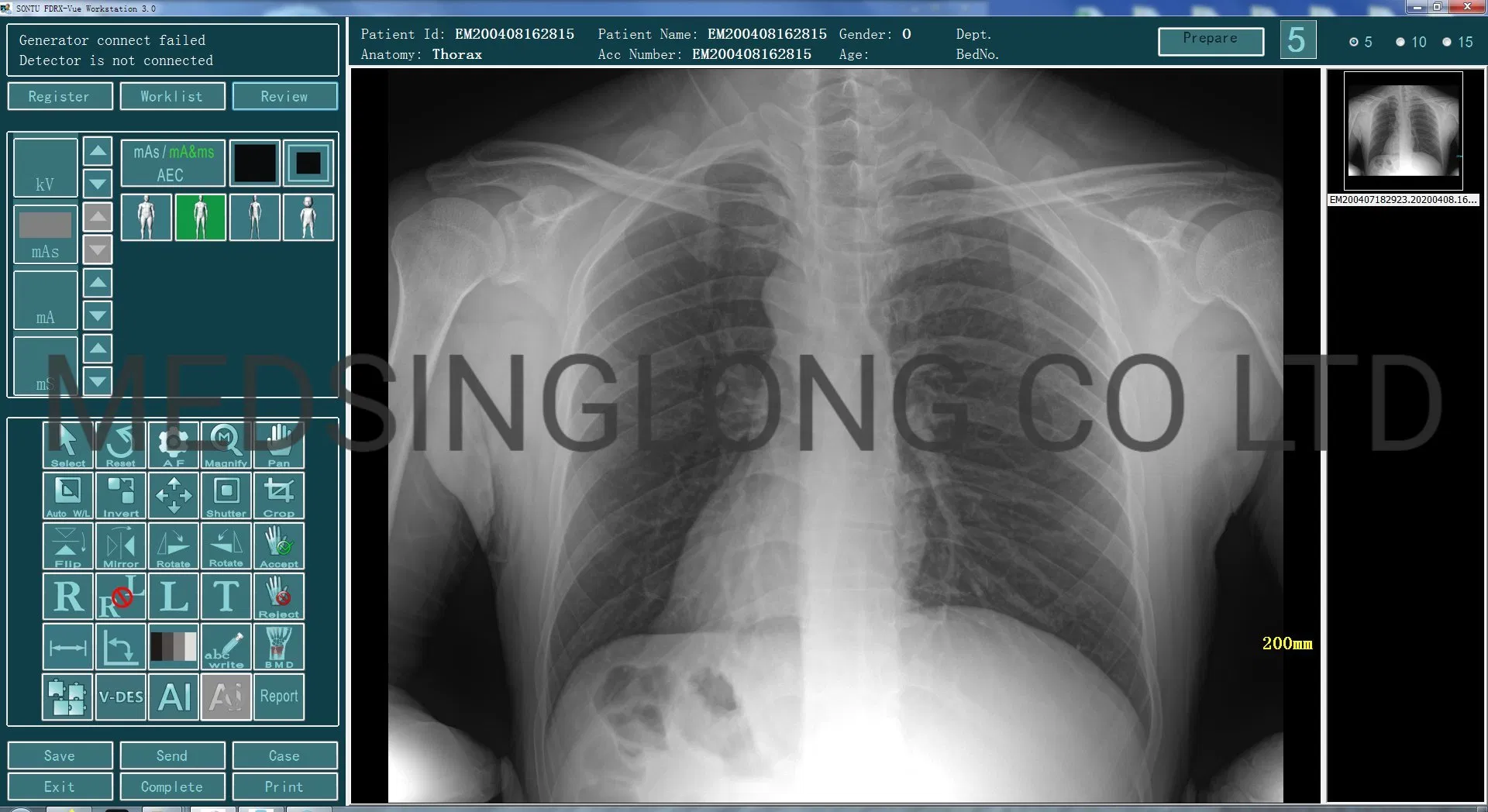 Mobile X Ray Machine Touch Screen Digital Chest Xray Machine Price Hospital Equipment