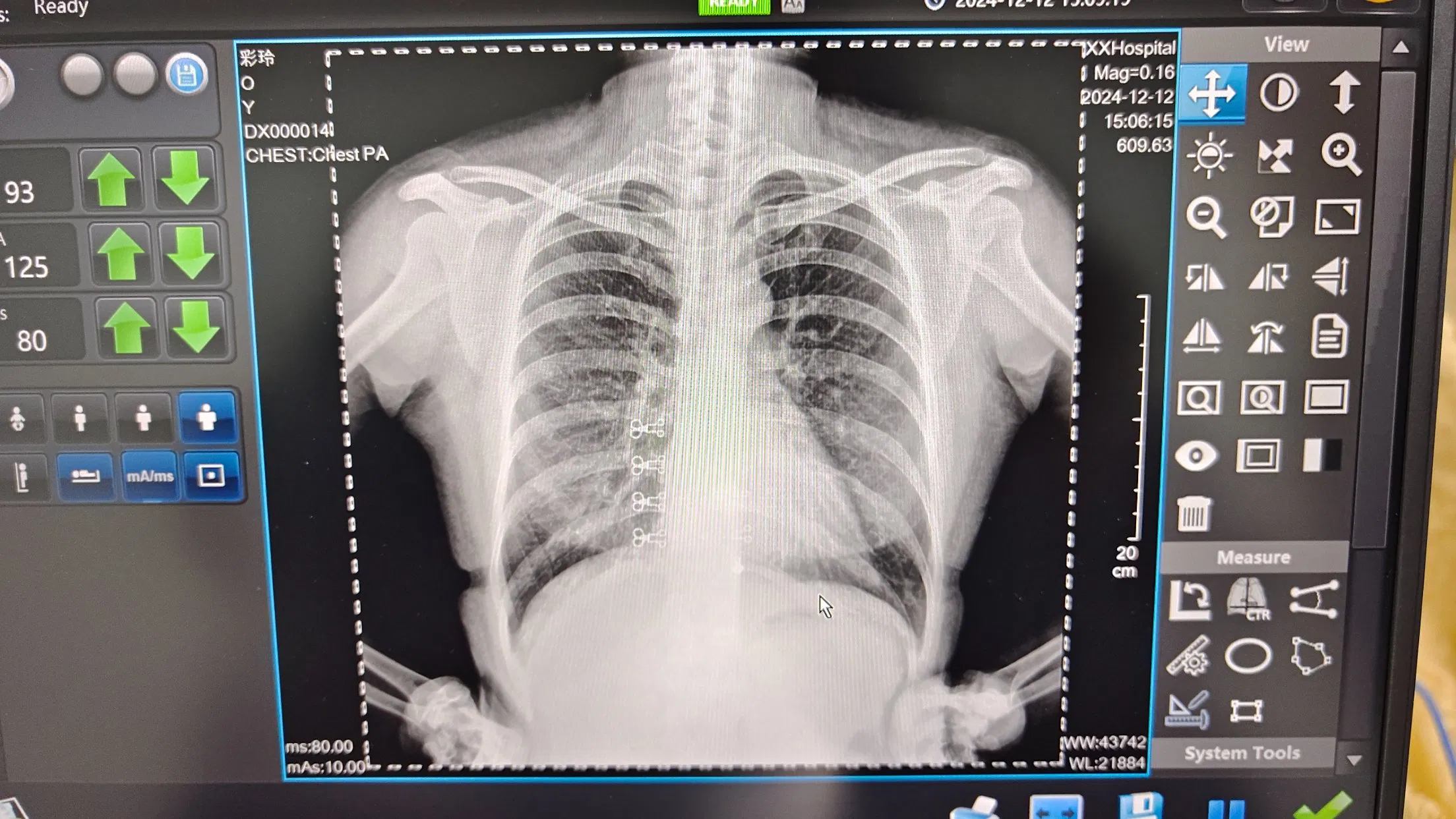 Handheld X-ray Camera Medical Lmage Solution Xm56e