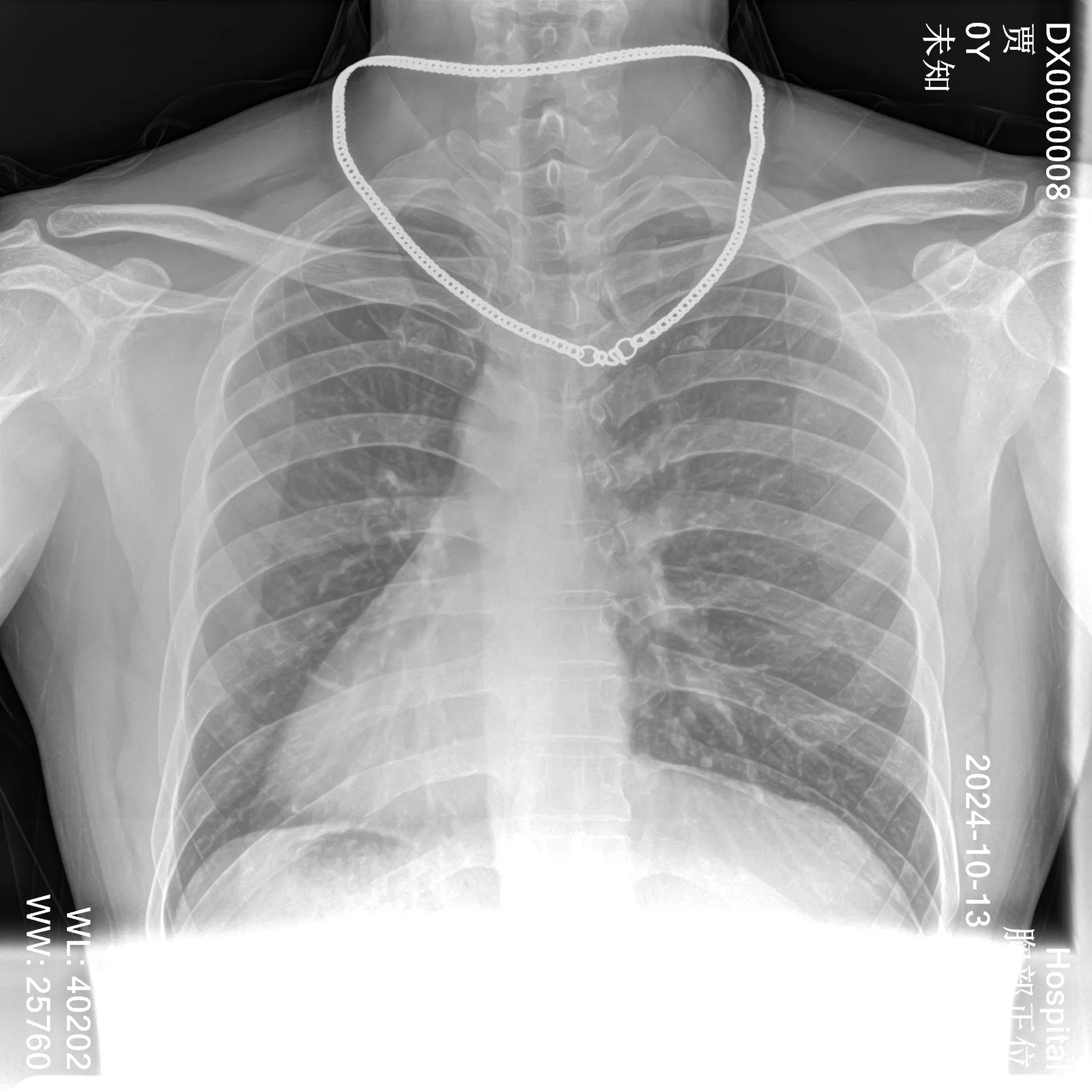 Handheld X-ray Camera Medical Lmage Solution Xm56e