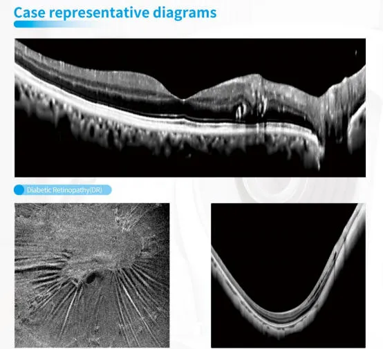 Glaucoma Screening