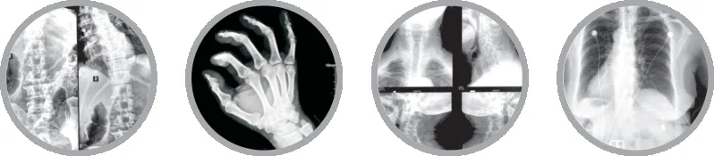 High-Frequency Mobile C-Arm X-ray System