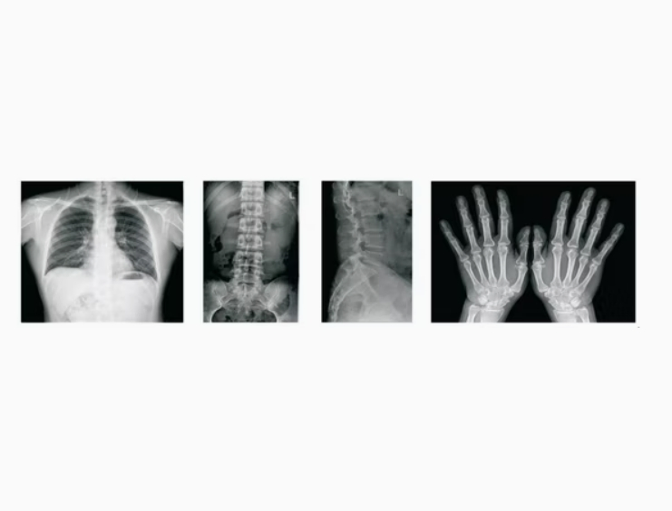 High-Frequency Mobile C-Arm X-ray System with Digital Radiography (DR) and Dynamic Film Detector