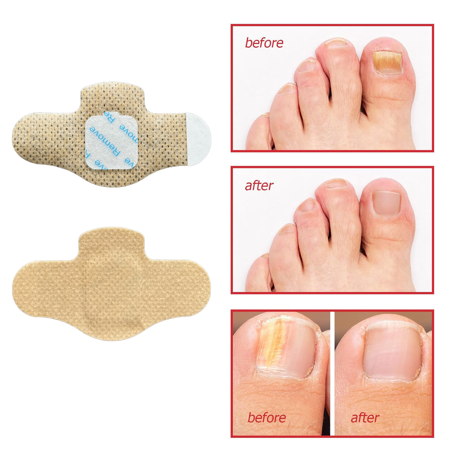 Fast Effective Moisten Toe Nail Repair Patch,Treats Prevents Fungus Ingrown Nail Correction Patch,Nail Fungus Patch