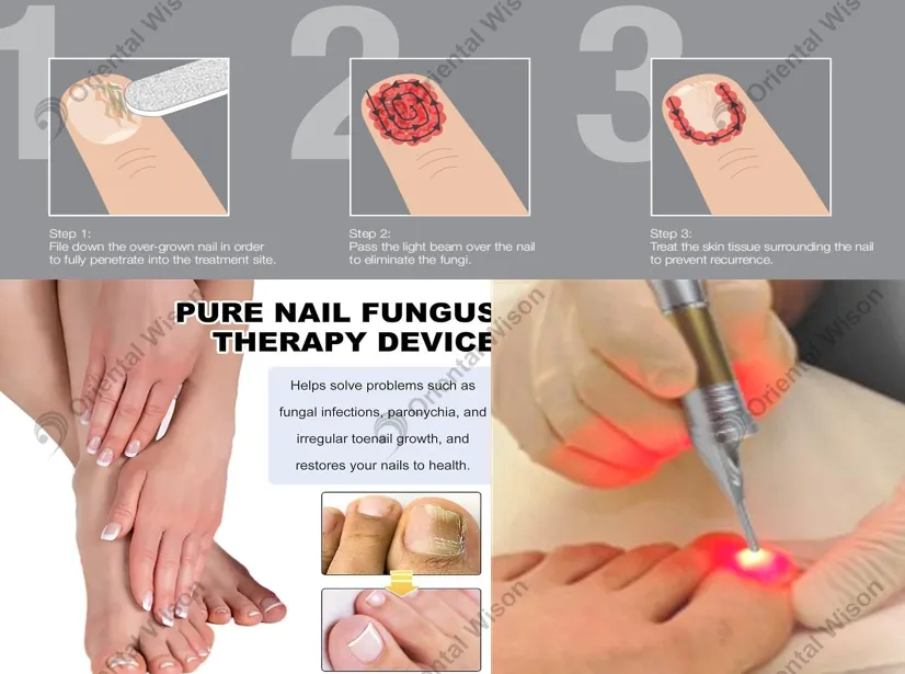 Nail Fungus Treatment