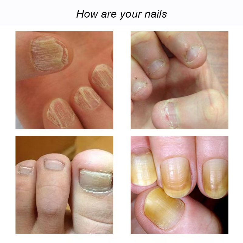 Gray Nail Polish Uneven Thick Spot Soft Repair Fluid Nail Serum for Repair Finger Edge Nail Polish Repair Fluid