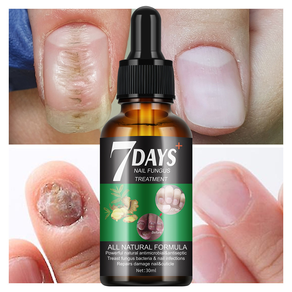 Wholesale 7 Day Natural Repairing Preventing Anti-Fungal Nail Treatment Nail Fungus Serum
