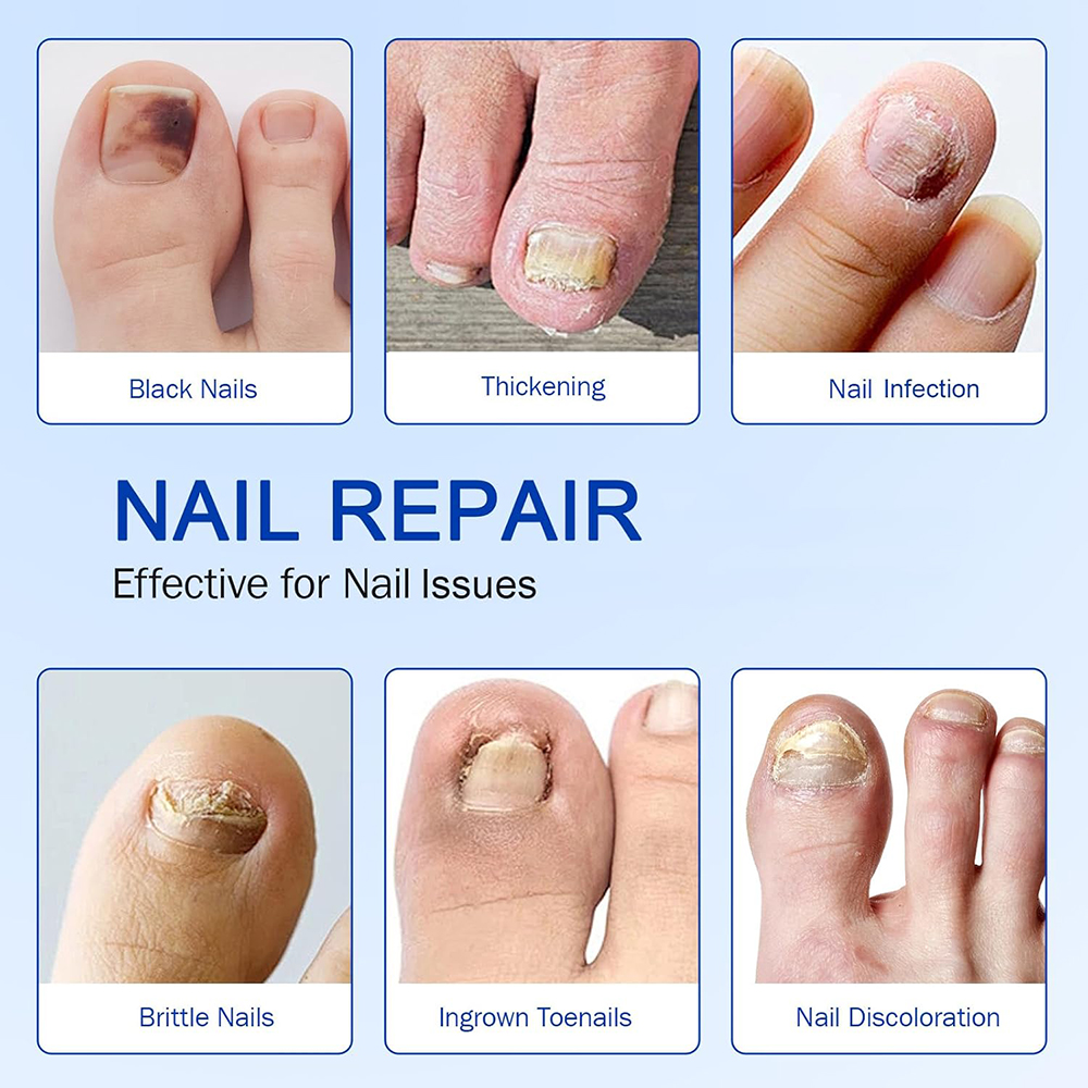Fast Effective Moisten Toe Nail Repair Patch,Treats Prevents Fungus Ingrown Nail Correction Patch,Nail Fungus Patch