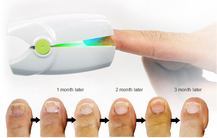China Manufacturer Hnc 905nm Laser Nail Fungus Treatment Device with High Quality