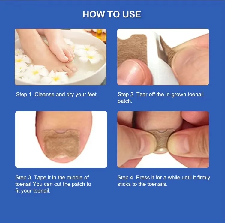 Pedicure Corrector Patch and Nail Correction Tool and Painless Corrector