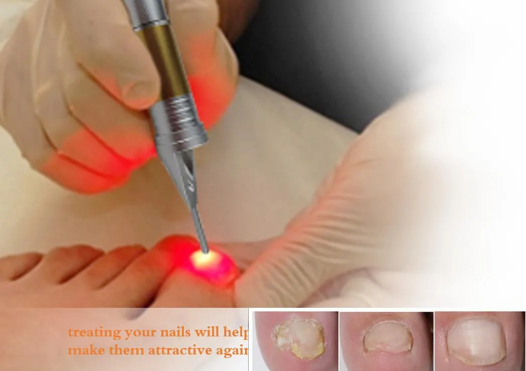 980nm Laser Nail Fungus Treatment Technology