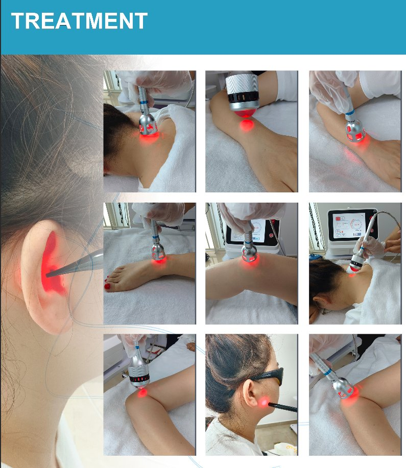 Portable Class 4 Hilt Physiotherapy Machine 980nm 810nm 1064nm Wavelengths Fisioterapia and Nail Fungus Treatment