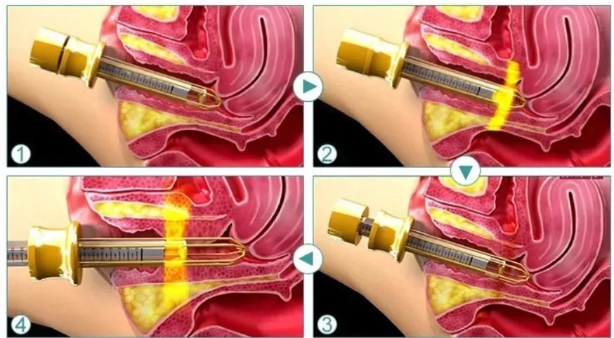 Mechanism of Action Image 2