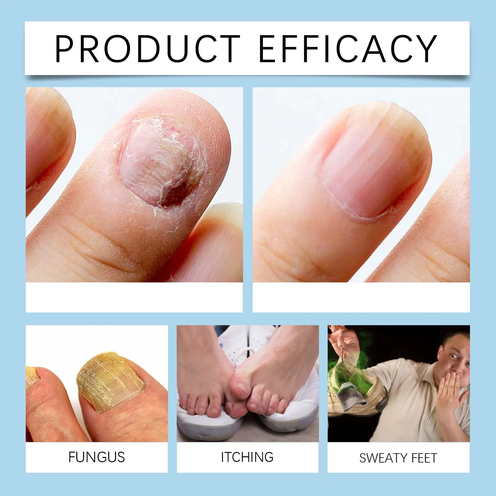 Professional Fungal Nail Gel Finger Feet Nail Care Toe Nail Fungus Treatment