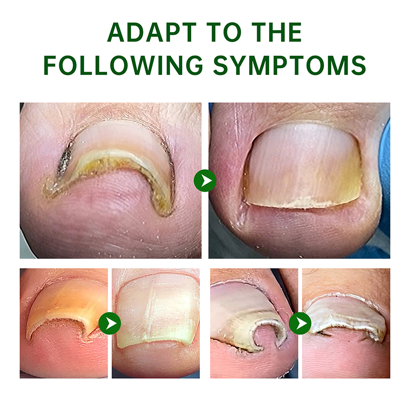 Private Label Nail Repair Oil Anti Infection Paronychia Onychomycosis Feet Care Nail Fungus Removal Gel Care