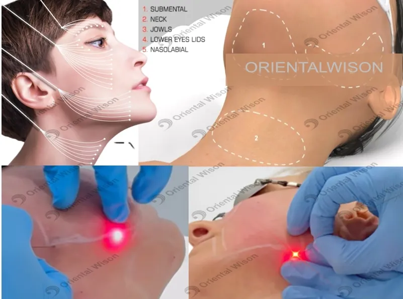 Laser Lipolysis