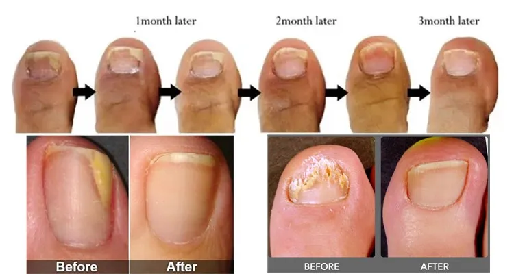 Before and After Nail Treatment Results
