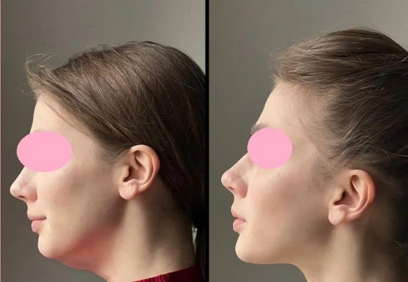 Before and After 1
