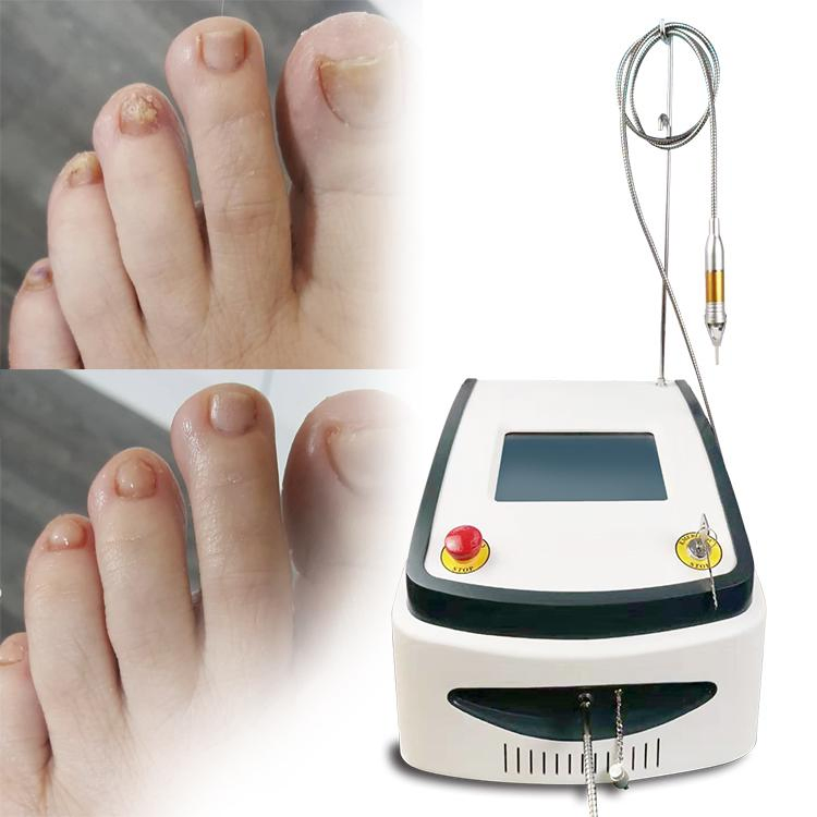 Best Sale 980nm Diode Laser Nails Fungus Treatment Physiotherapy Plantar Warts Removal