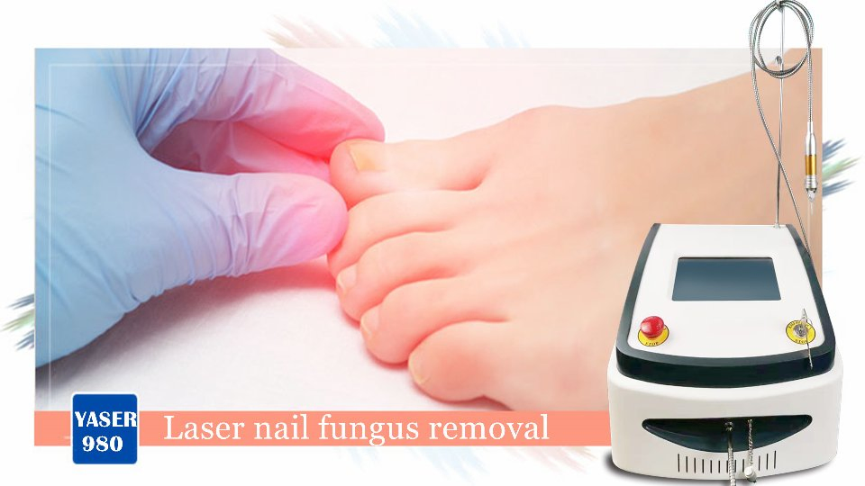 Best Sale 980nm Diode Laser Nails Fungus Treatment Physiotherapy Plantar Warts Removal