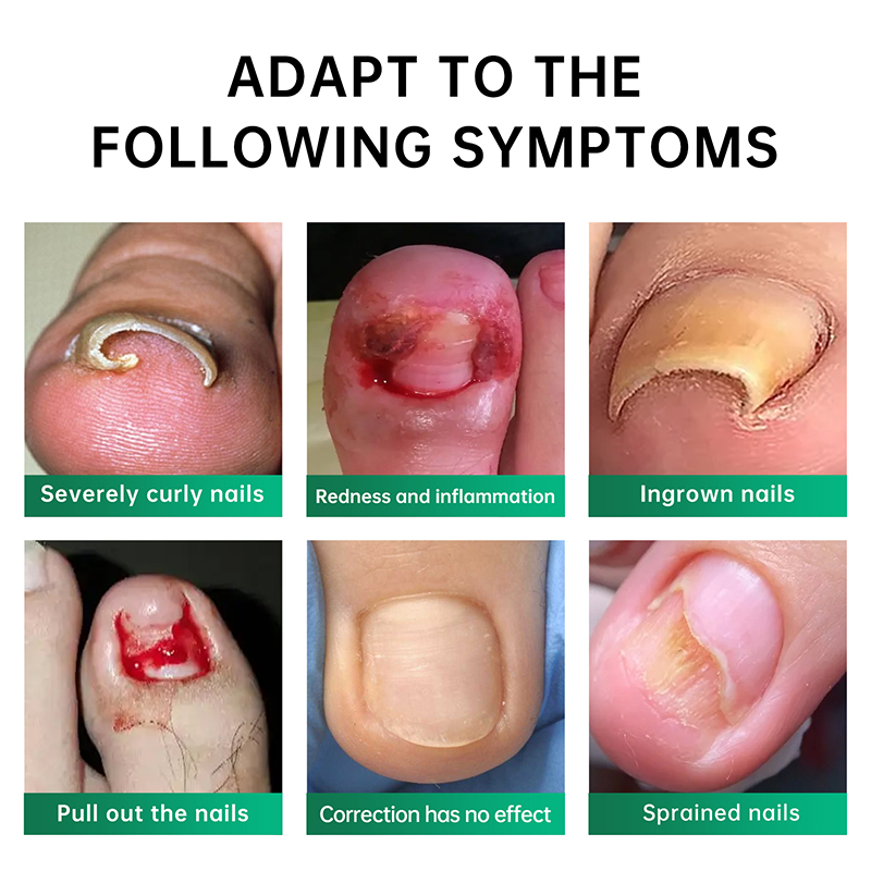 Private Label Nail Repair Oil Anti Infection Paronychia Onychomycosis Feet Care Nail Fungus Removal Gel Care