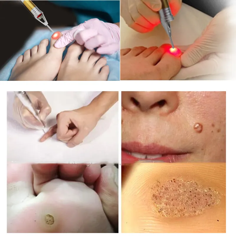 Laser Nails Fungus Treatment