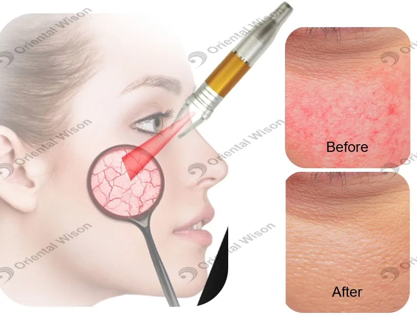 Spider Veins Removal