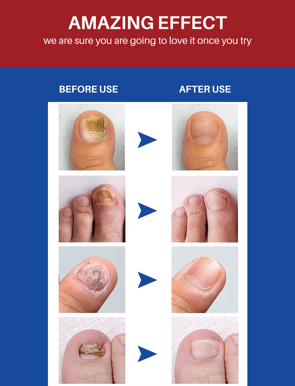 LANTHOME 10ml Nail Repair Solution Clean Whiten Nourish Nails Fungal Treatment Toe Nail Fungus Treatment