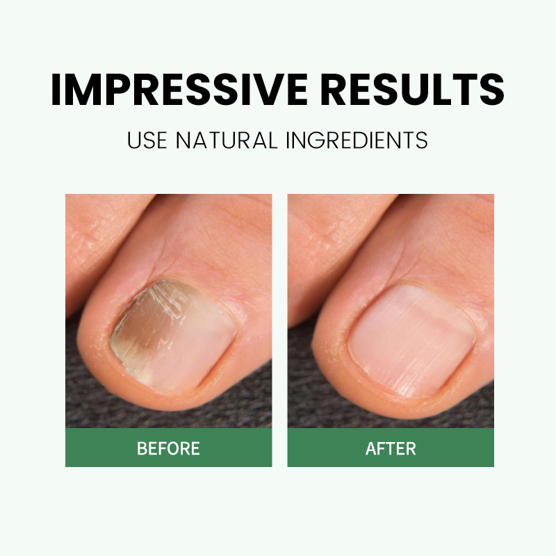 Wholesale Korean Nail Care Products Personal Nail Fungus Pen for Toenail &amp; Fingernail Treatment Cuticle Oil Repair Pen