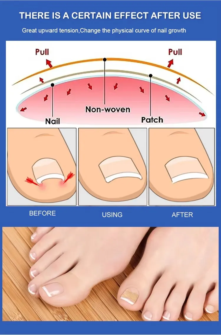 Pedicure Corrector Patch and Nail Correction Tool and Painless Corrector