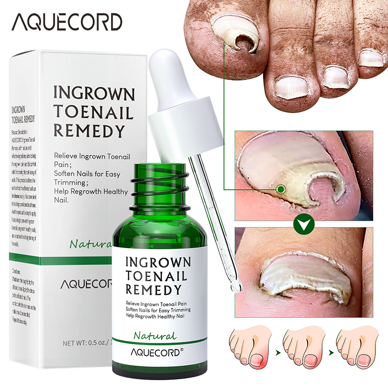 Private Label Nail Repair Oil Anti Infection Paronychia Onychomycosis Feet Care Nail Fungus Removal Gel Care