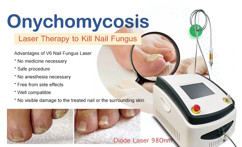 980nm Laser Fungus Treatment Device