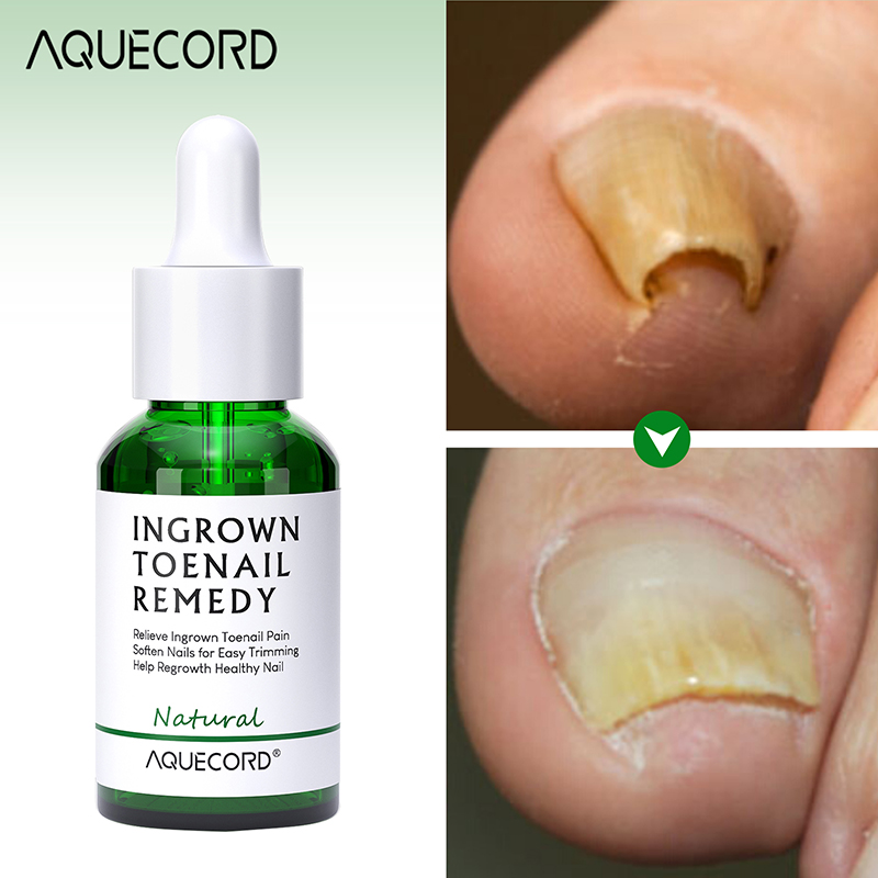 Private Label Nail Repair Oil Anti Infection Paronychia Onychomycosis Feet Care Nail Fungus Removal Gel Care