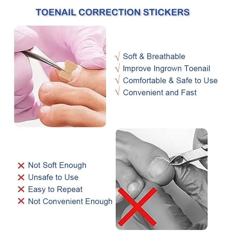 Pedicure Corrector Patch and Nail Correction Tool and Painless Corrector