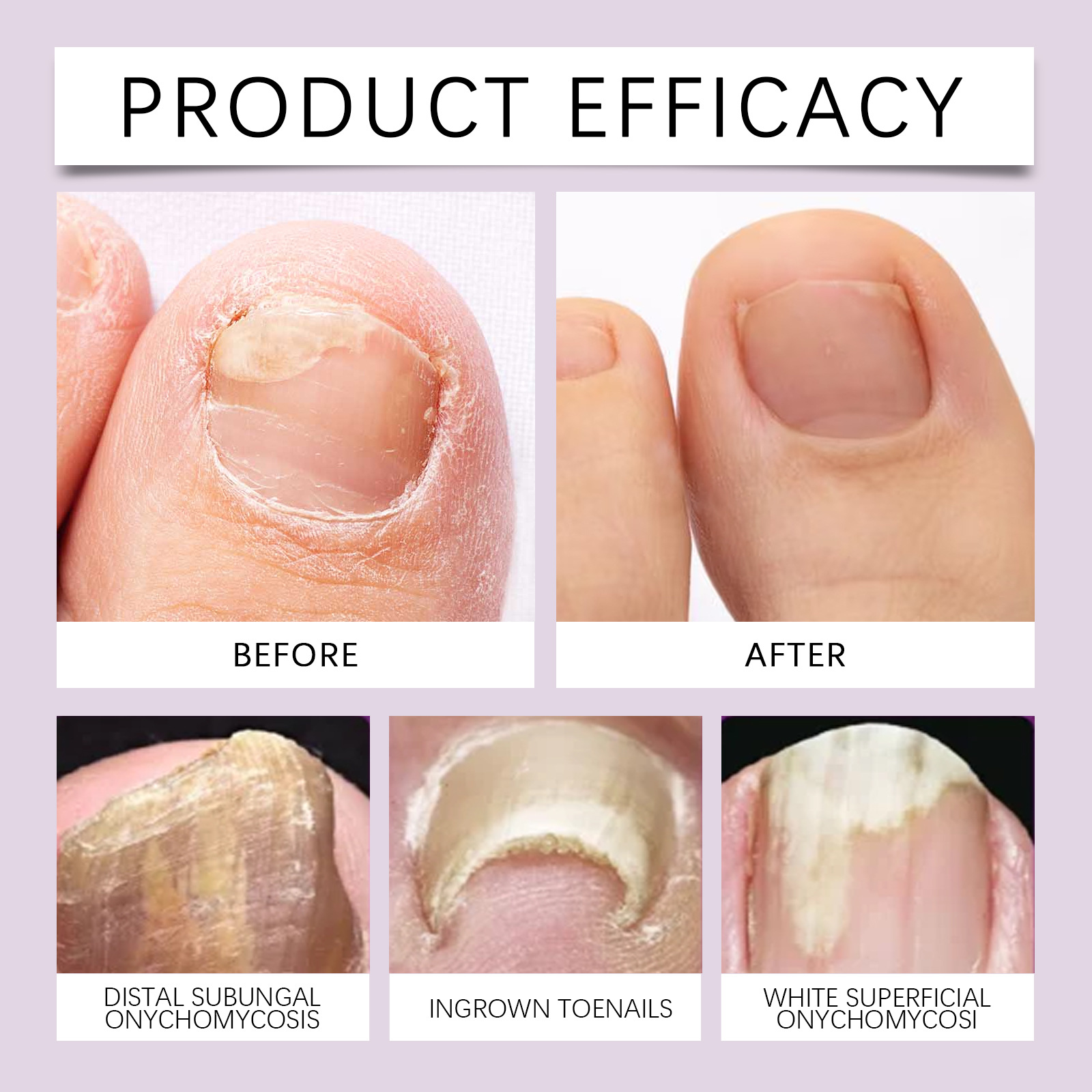 2025 Factory Direct Sale Natural Ingredient Nail Fungus Specialized Cleansing Repair Nutrient Liquid Foot Care