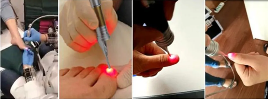 Nail Treatment Comparison Diagram