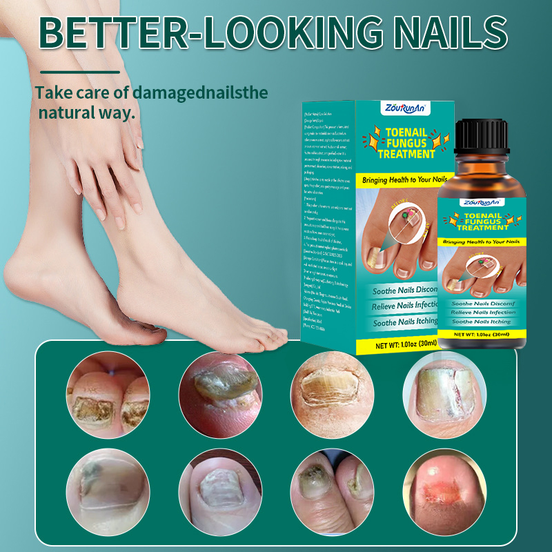 Herbal Extractions Toenail Fungus Treatment for Strengthening Weak Damaged Nails