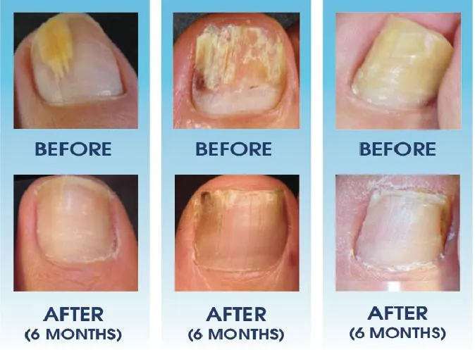 Nail Regrowth Timeline Diagram