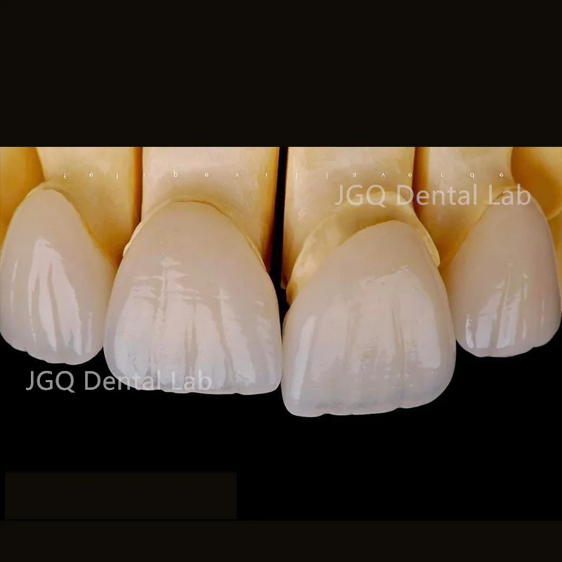 Zirconia Crown