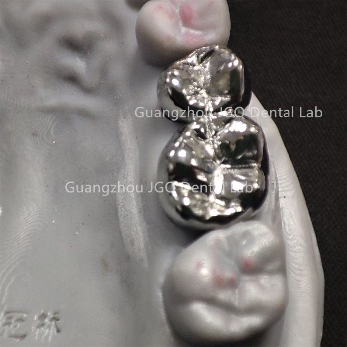 Full Service Dental Lab Custom Titanium Alloy Metal Crowns 3D Printing Best Affordable Price