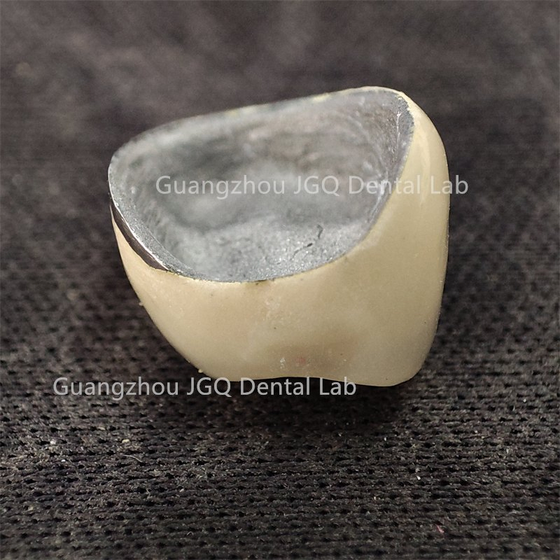 Full Service Dental Lab Custom Titanium Alloy Metal Crowns 3D Printing Best Affordable Price