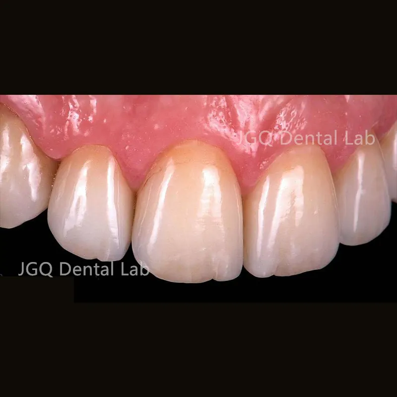 Zirconia Crown