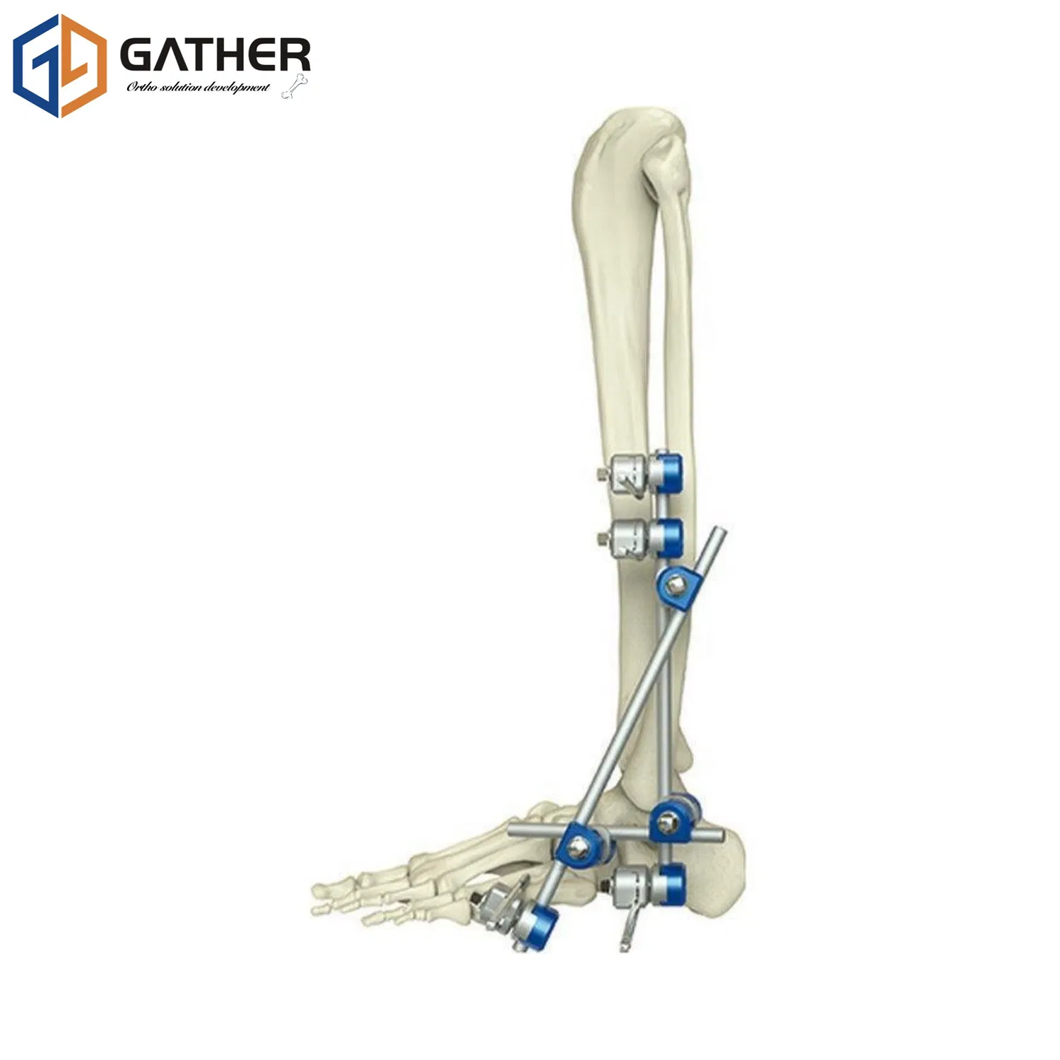 Manufacture Gather Biotech Factory Price Carbon Fiber Fixation External Fixator