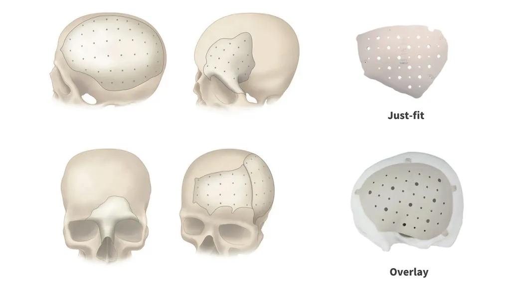 PEEK Patient Specific Implant for Craniomaxillofacial Repair