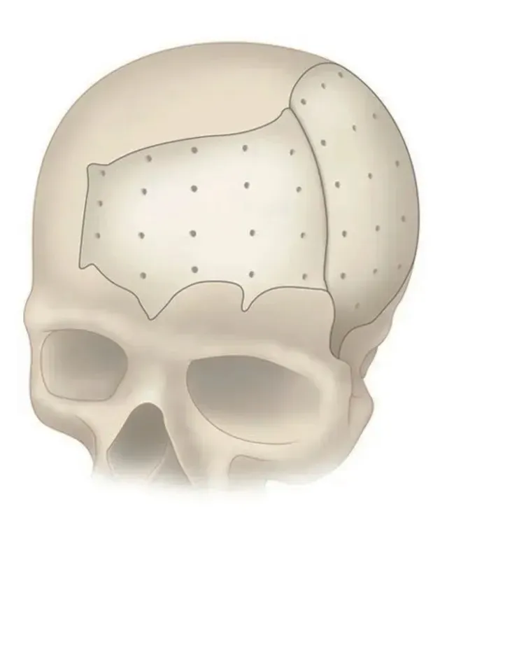 Maxillofacial Repair System Image 4